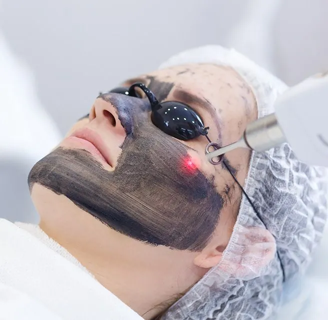 Carbon laser peel in progress